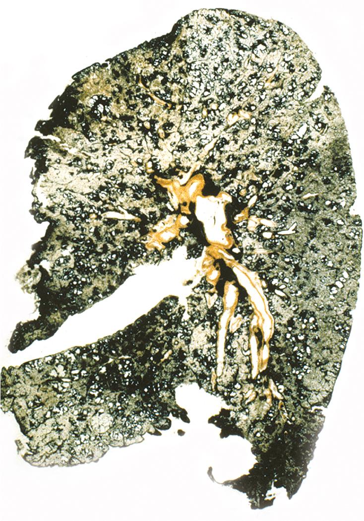 Figure 10.18, Simple coal worker’s pneumoconiosis. In contrast to normal lung, this thin section shows diffusely increased pigment resulting from the deposition of coal dust.