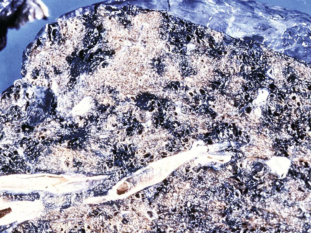 Figure 10.19, Simple coal worker’s pneumoconiosis. In addition to diffusely increased pigmentation, the lung parenchyma shows well-demarcated black nodules. Emphysematous bullae are also present.