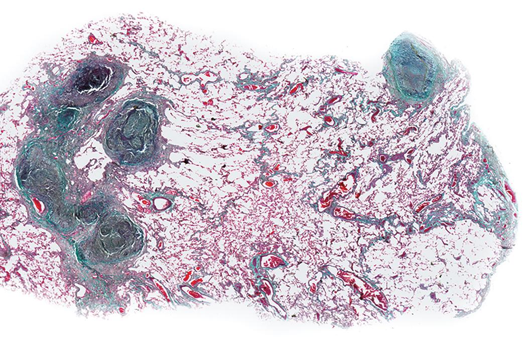 Figure 10.2, Silicosis. At low magnification, silicotic nodules appear sharply circumscribed and densely collagenous (Masson trichrome stain).