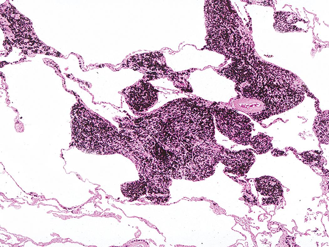 Figure 10.21, Simple coal worker’s pneumoconiosis. The coal dust macule is characterized by focal interstitial pigment deposition. In this example, destruction of the adjacent alveolar septa, termed focal emphysema, is also seen.