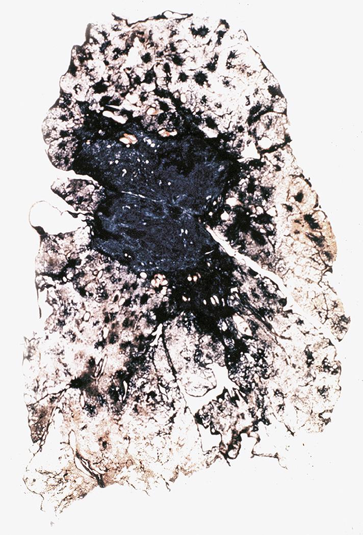 Figure 10.23, Complicated coal worker’s pneumoconiosis. In this thin section, a large black irregular fibrotic lesion has destroyed the perihilar lung parenchyma.