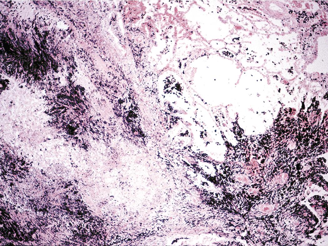 Figure 10.24, Complicated coal worker’s pneumoconiosis. In this example of progressive massive fibrosis, haphazardly arranged collagen bundles are interspersed with abundant pigment.