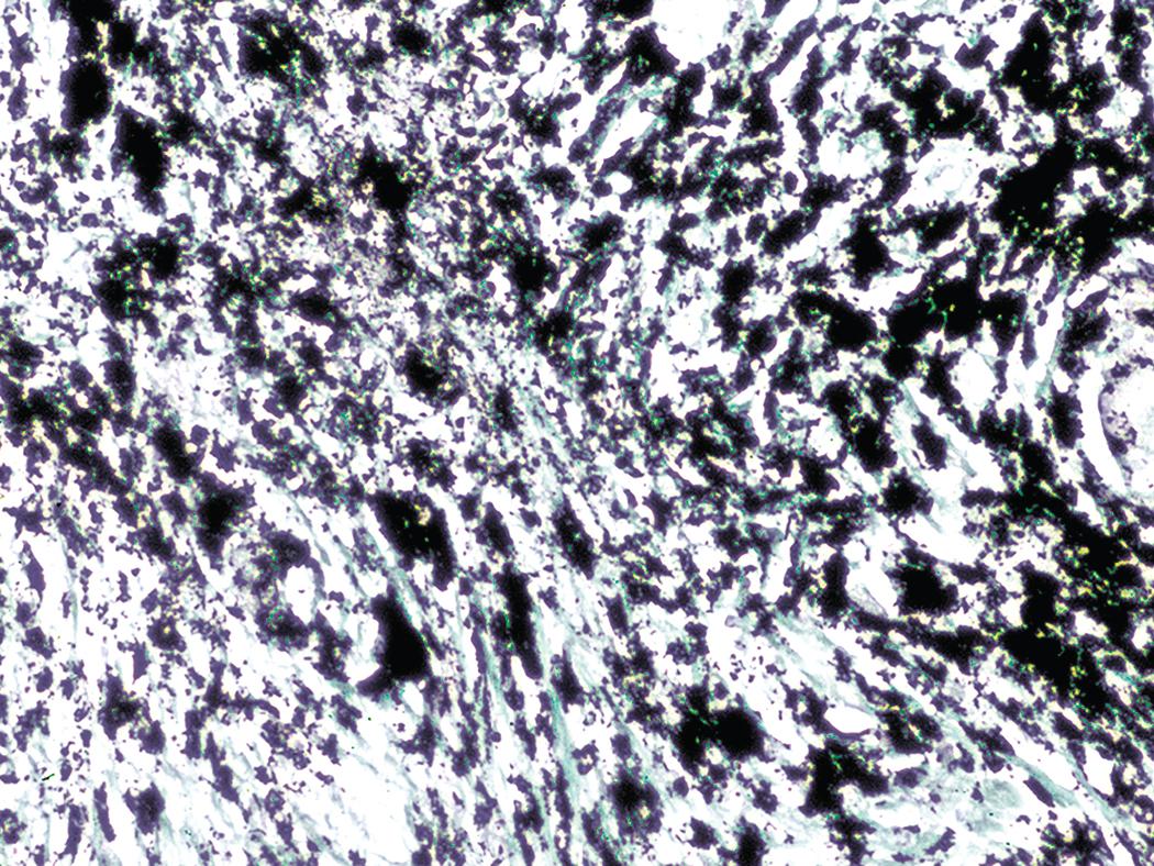 Figure 10.25, Complicated coal worker’s pneumoconiosis. Masson trichrome stain highlights the collagenous composition of a heavily pigmented region of progressive massive fibrosis.