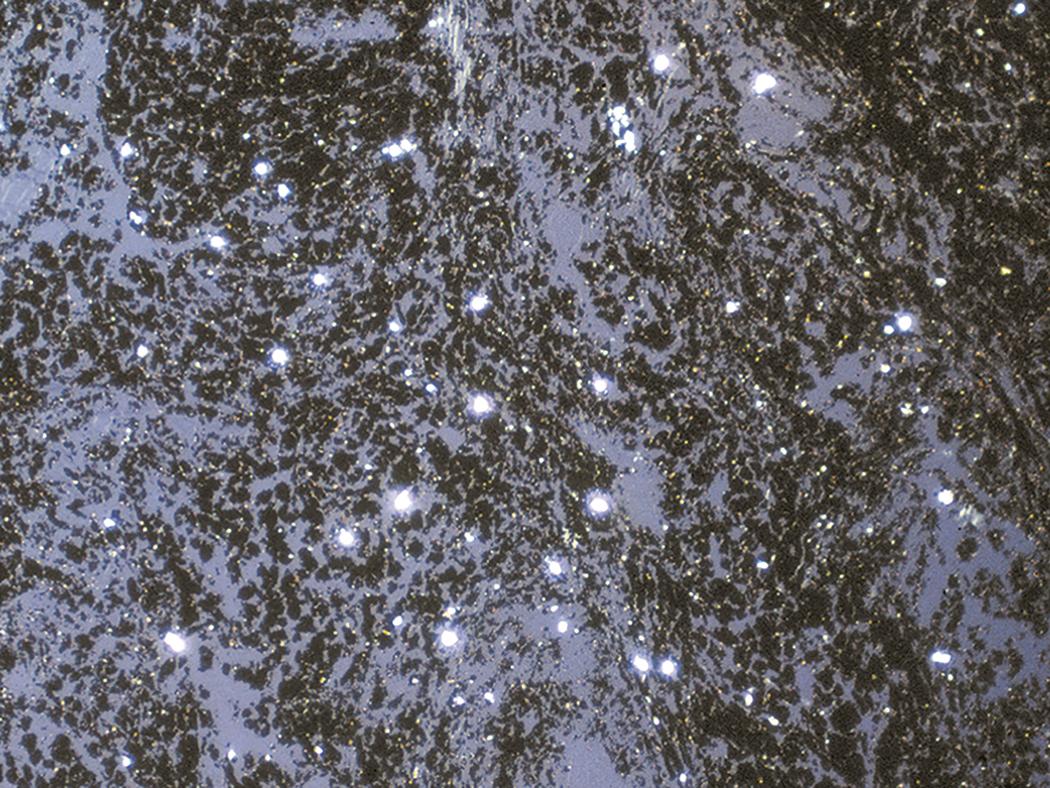 Figure 10.26, Coal worker’s pneumoconiosis. Partial polarization shows a mixture of faintly and brightly birefringent particles superimposed on black pigment.