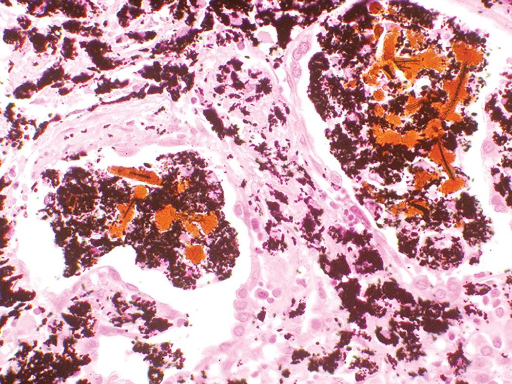 Figure 10.27, Coal worker’s pneumoconiosis. Along with pigmented macrophages, this case demonstrates numerous intraalveolar ferruginous bodies.