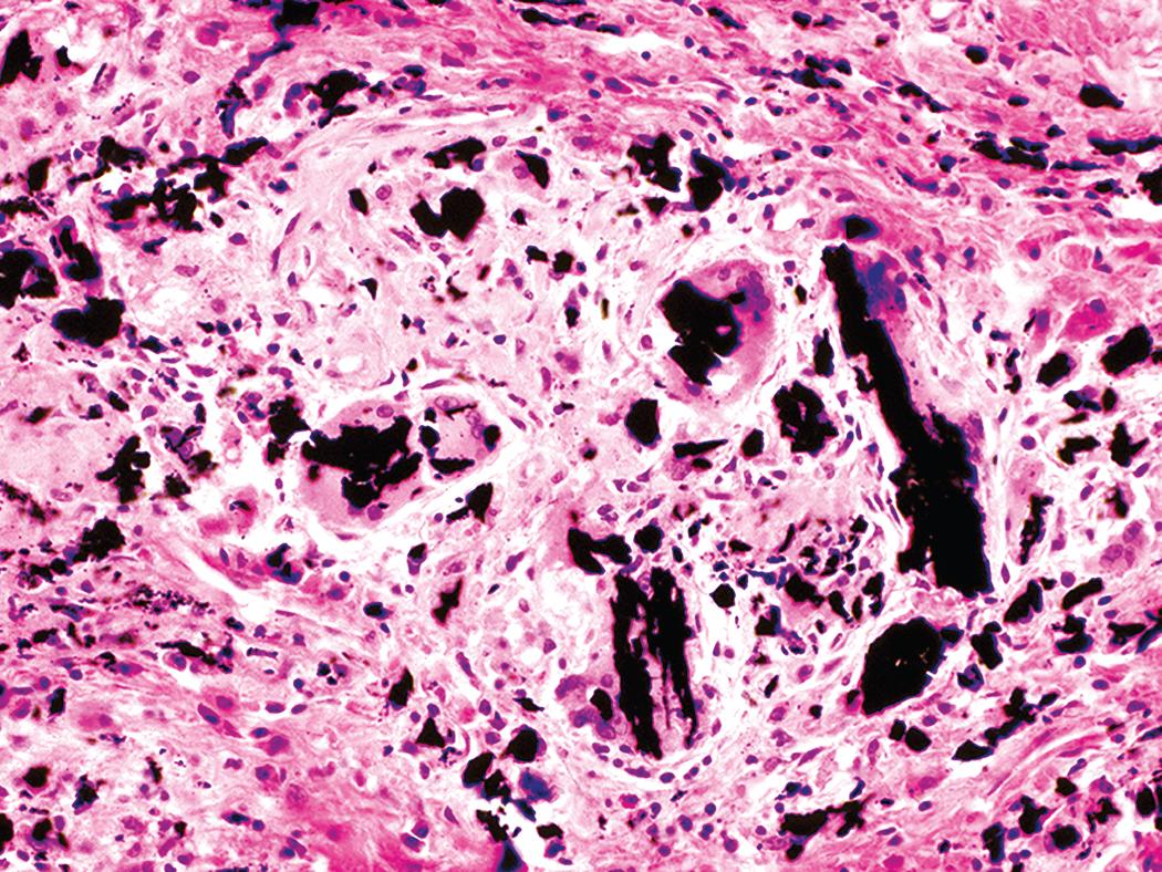 Figure 10.30, Graphite pneumoconiosis. Although somewhat similar in appearance to particulates in coal worker’s pneumoconiosis, graphite particles appear crystalline and elicit a giant cell reaction.