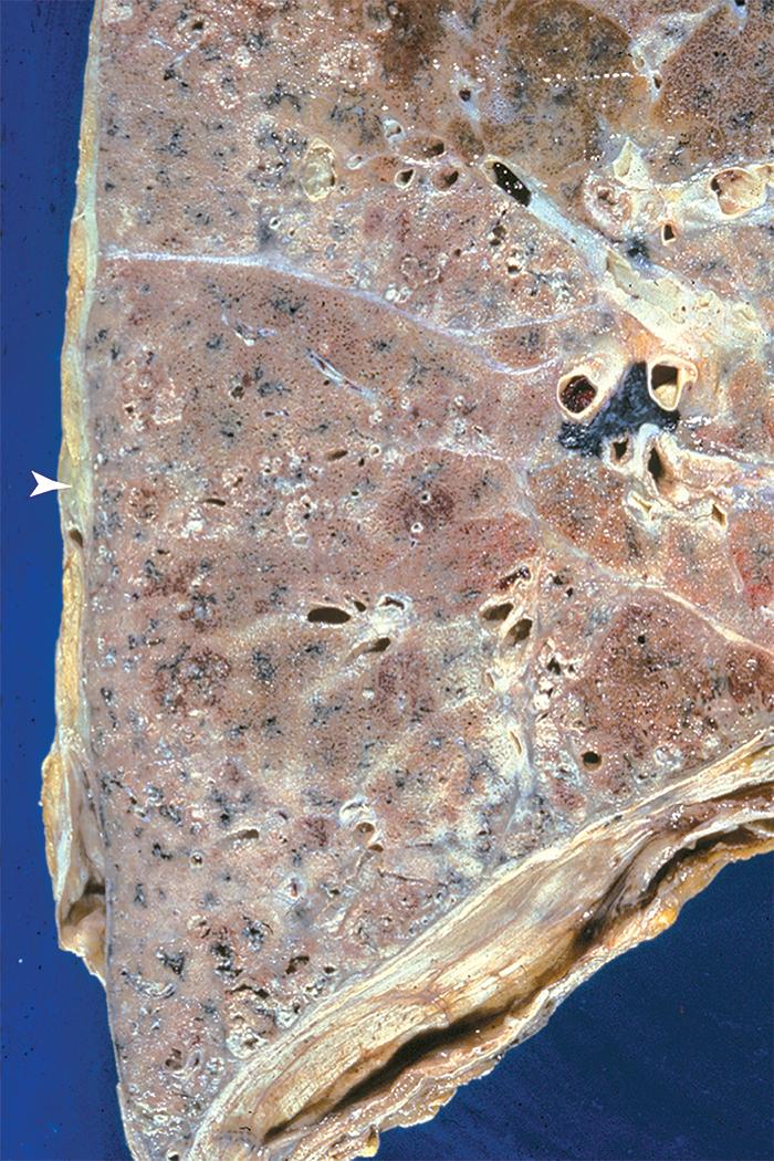 Figure 10.31, Asbestosis. The lower lobe parenchyma shows patchy fibrosis. Visceral pleural thickening also is evident (arrowhead) .