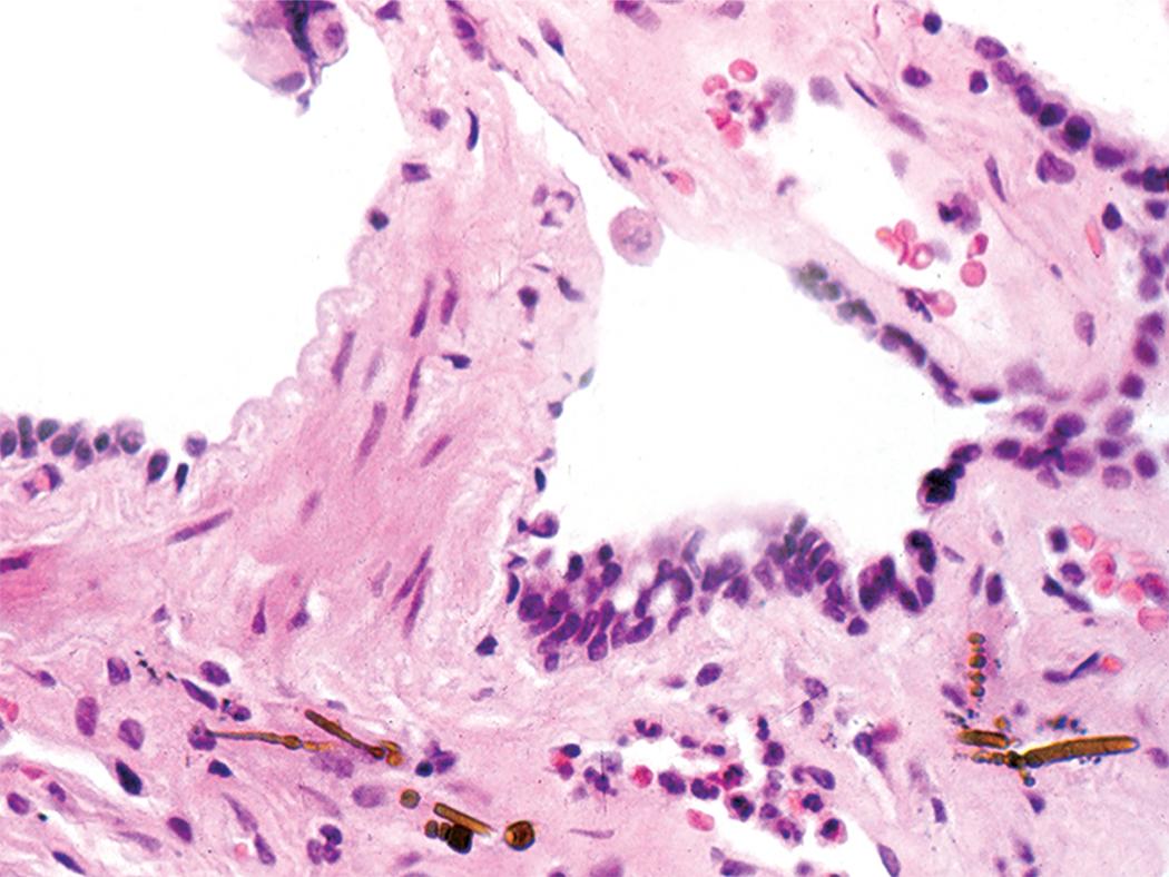 Figure 10.33, Asbestosis. The histologic hallmarks of asbestosis are peribronchiolar fibrosis accompanied by asbestos bodies.