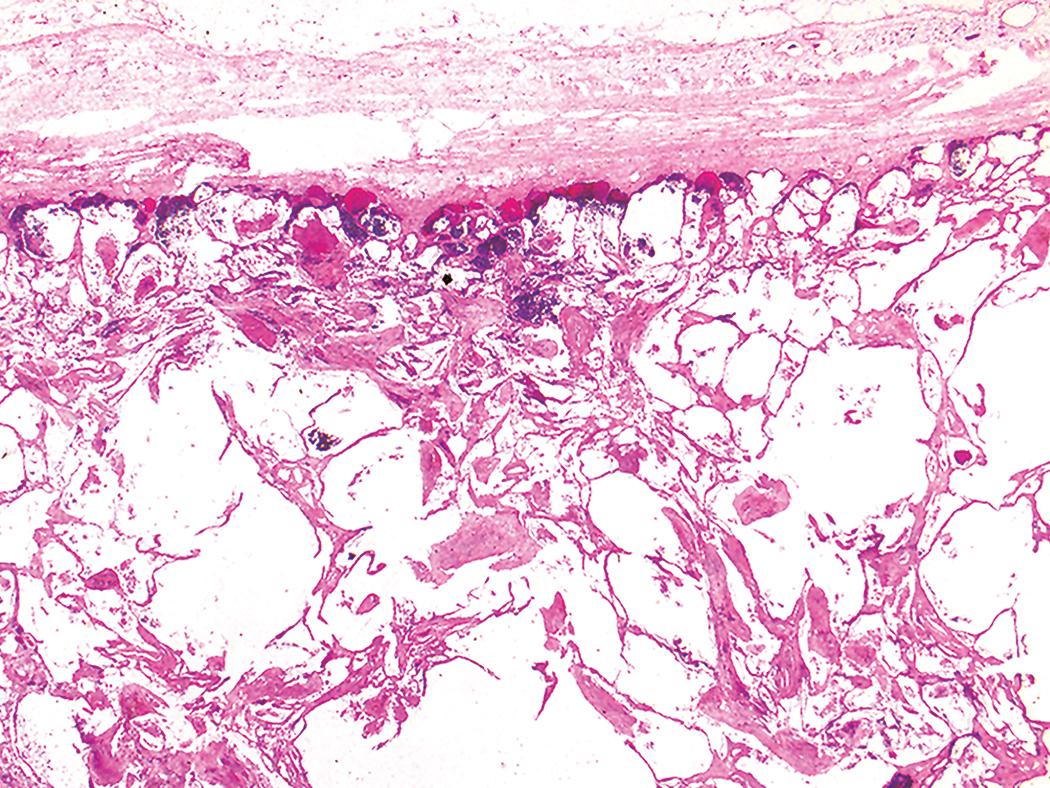 Figure 10.35, Asbestosis. Peribronchiolar fibrosis extends into adjacent alveolar septa. Centrilobular emphysema and visceral pleural fibrosis (top) are also seen.