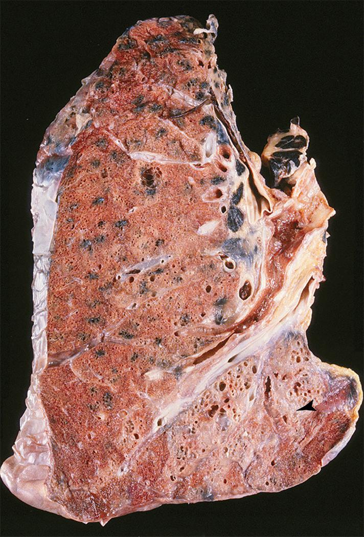 Figure 10.36, Asbestosis. In advanced cases, honeycombing (arrowhead) is seen in addition to lower lobe fibrosis.