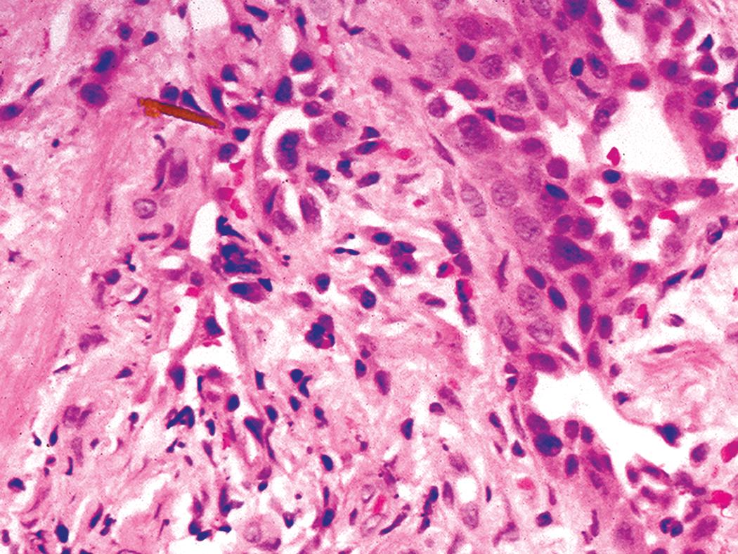 Figure 10.39, Asbestosis. Interstitial fibrosis and an asbestos body (upper left) are seen in this transbronchial biopsy specimen.