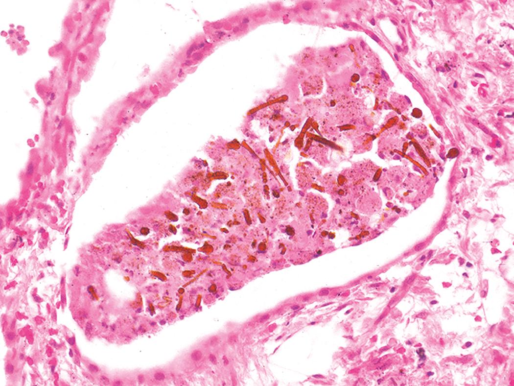 Figure 10.40, Asbestosis. Asbestos bodies are present within an alveolar space in this case of severe asbestosis.