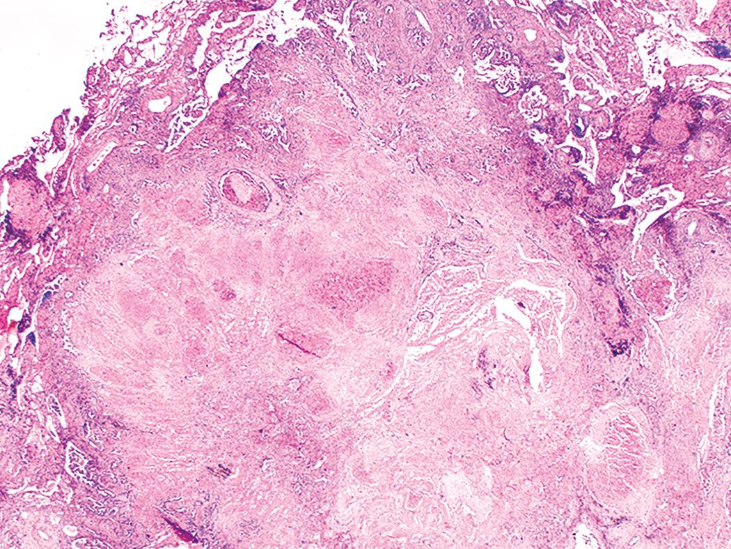 Figure 10.4, Conglomerate silicosis. Multiple silicotic nodules have coalesced to form an area of confluent fibrosis.