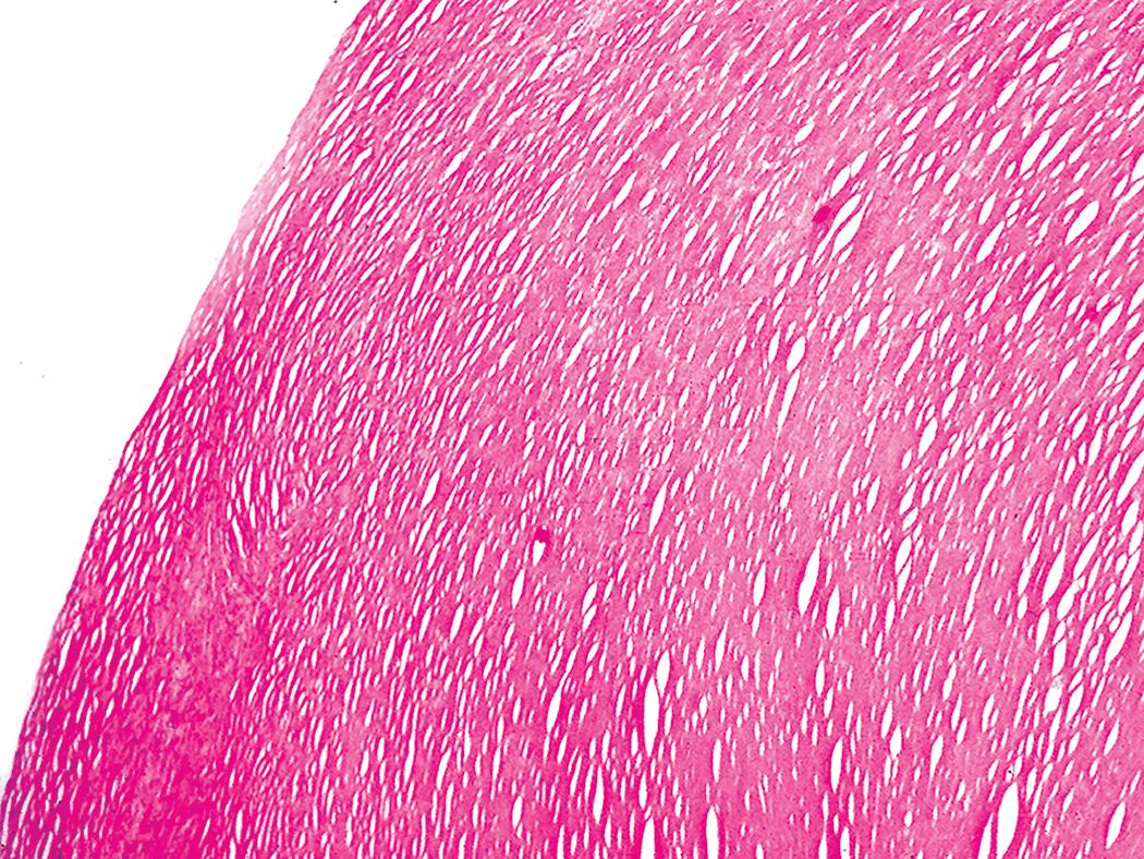 Figure 10.44, Pleural plaque. These lesions are typically composed of layers of acellular hyalinized collagen arranged in a “basket-weave” pattern.