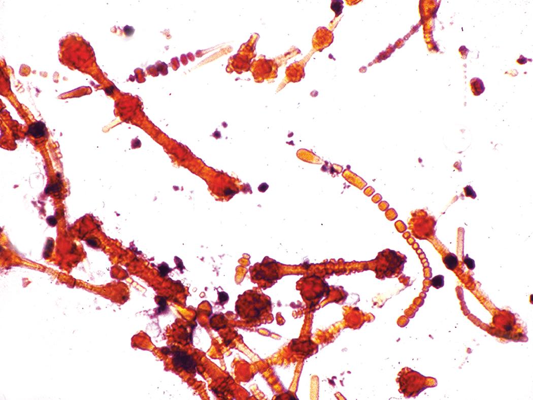Figure 10.45, Asbestosis. Asbestos bodies from a lung tissue digest on a Nuclepore filter.