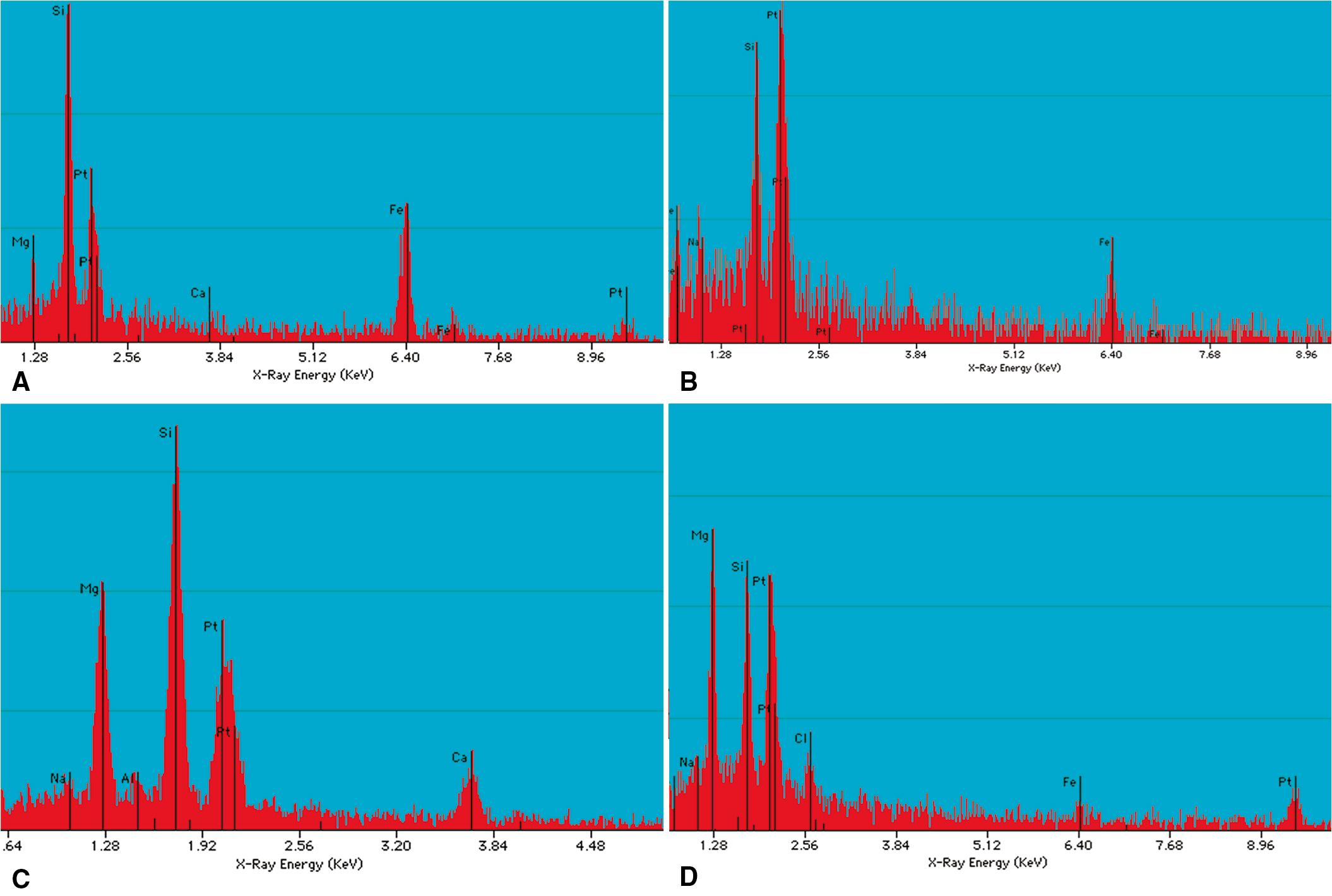 Figure 10.47, Asbestosis. Energy-dispersive x-ray analysis spectra showing characteristic elemental composition of types of asbestos. (A) Amosite has a prominent peak for silicon (Si) as well as peaks for magnesium (Mg) and iron (Fe) . (B) Crocidolite shows a peak for sodium (Na) in addition to silicon and iron. (C) Tremolite demonstrates peaks for silicon, magnesium, and calcium (Ca) . (D) Chrysotile exhibits prominent peaks for magnesium and silicon. The peak for platinum (Pt) represents the coating applied to the specimen prior to electron microscopic examination.