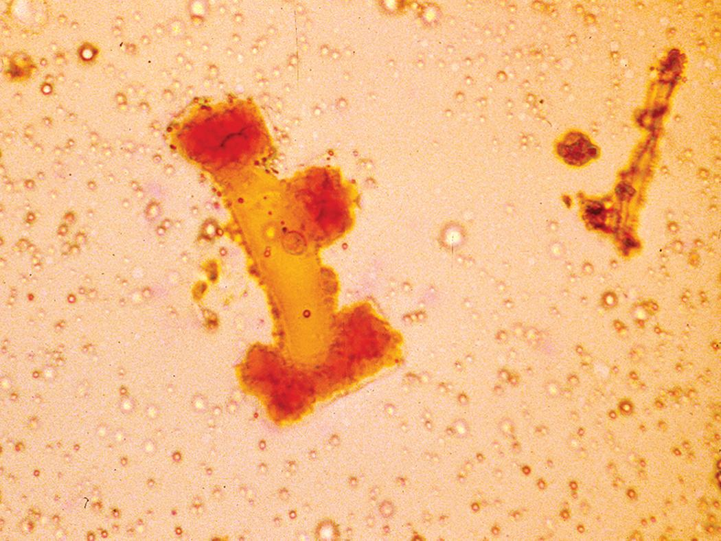 Figure 10.53, Silicatosis. Pseudoasbestos bodies with broad yellow sheet-silicate–type cores.