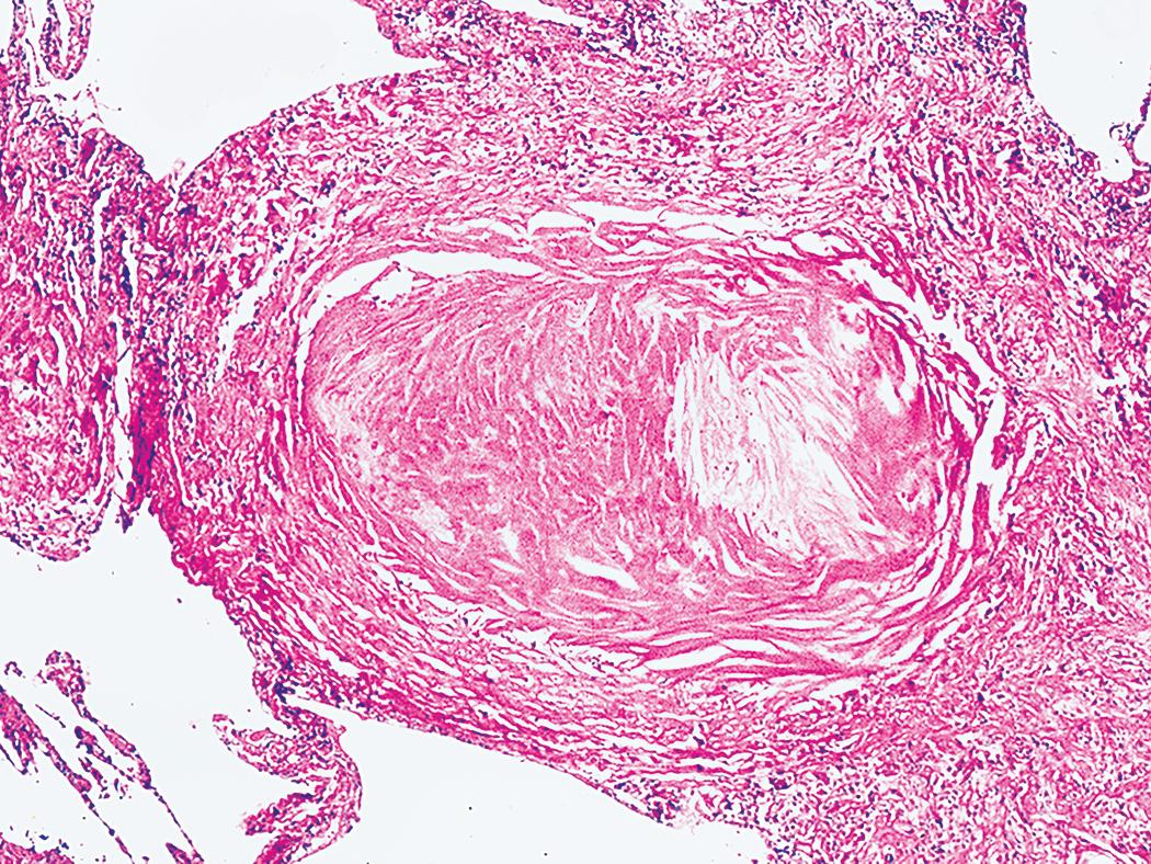 Figure 10.5, Silicosis. Silicotic nodule demonstrating a typical whorled appearance. Dust-laden macrophages are present at the periphery of the nodule.