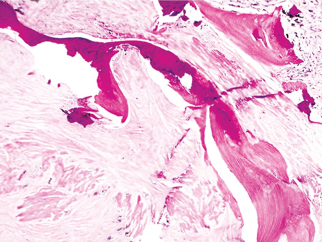 Figure 10.6, Silicosis. Silicotic nodule with partial ossification.