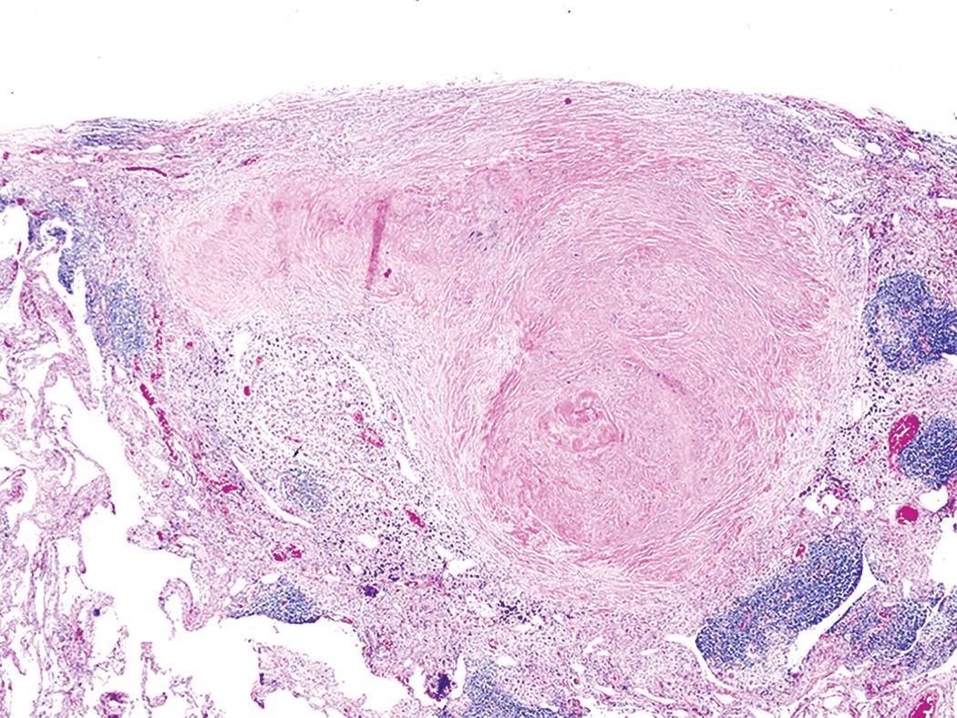 Figure 10.7, Silicosis. The lung parenchyma underlying the pleura is a common location for silicotic nodules.