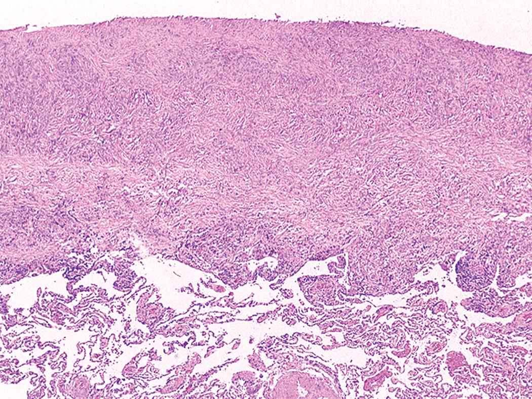 Figure 10.8, Pleural silicosis. Pleural involvement sometimes manifests as dense fibrosis.