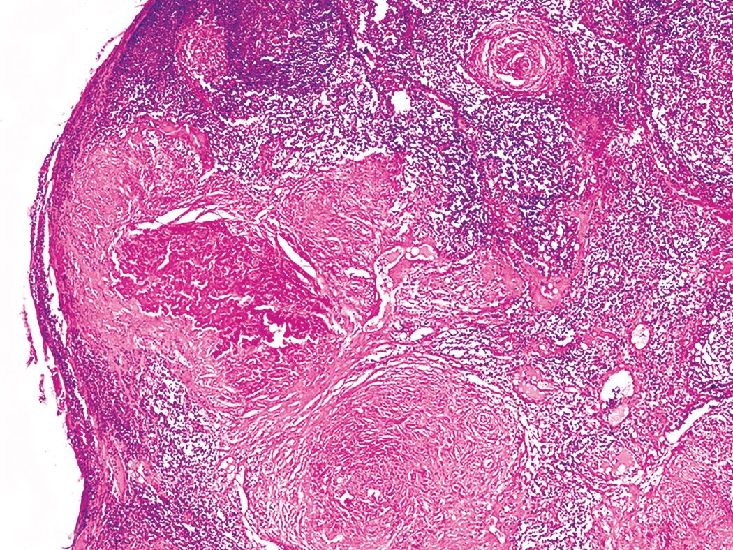 Figure 10.10, Silicosis. Silicotic nodules within a lymph node characteristically contain centrally dense, hyalinized collagen surrounded by concentric whorls of more loosely arranged collagen bundles.