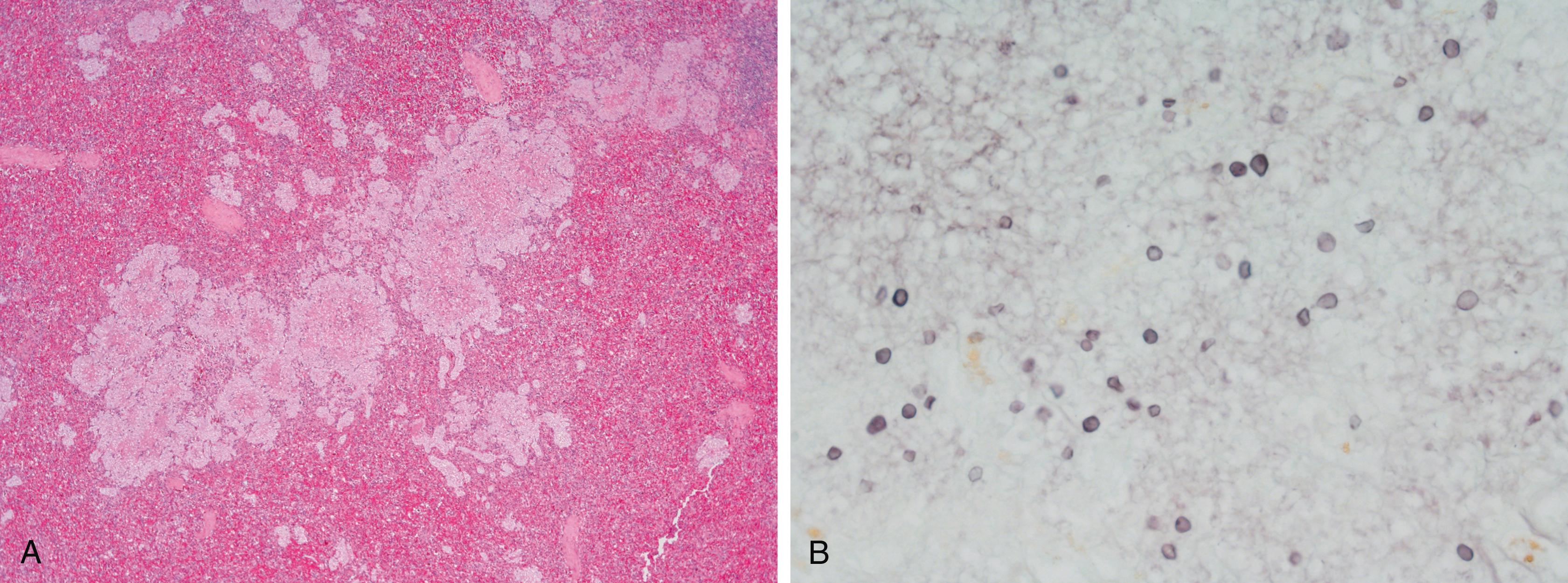 E-FIGURE 313-2, Histopathology of the spleen of a patient who died from disseminated Pneumocystis infection.