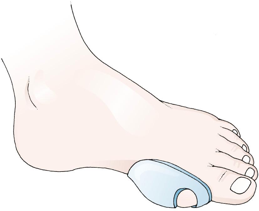 Figure 51.2, Use of an adhesive bunion pad. The hole in the pad is placed over the bunion and the surrounding pad absorbs the friction.