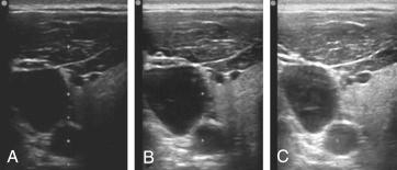 Fig. 32.2, Examples of under-gained (A), appropriately gained (B), and over-gained (C) images of the internal jugular vein. Note the poor differentiation of tissue in the under-gained image and increased artefactual features within the vein of the over-gained image.