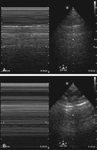Fig. 32.3, M-mode demonstration of pleural sliding within the chest wall. Image A shows “seashore sign” indicating motion of the pleural lining. Image B shows “bar code sign” indicating absent motion of the pleural lining suggestive of pneumothorax.