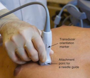 Fig. 32.5, The probe is held comfortably in the right hand like a pencil. The 4 th and 5 th fingers stabilize the probe and the hand is resting on the patient for stability. Note the line on the probe handle, this is the indicator mark and corresponds with the left of the screen.