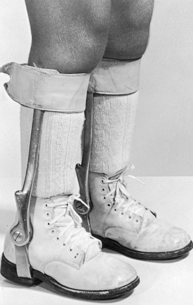 Fig. 33.2, Plantar flexion–assist below-knee orthosis with a dorsiflexion stop at neutral position.