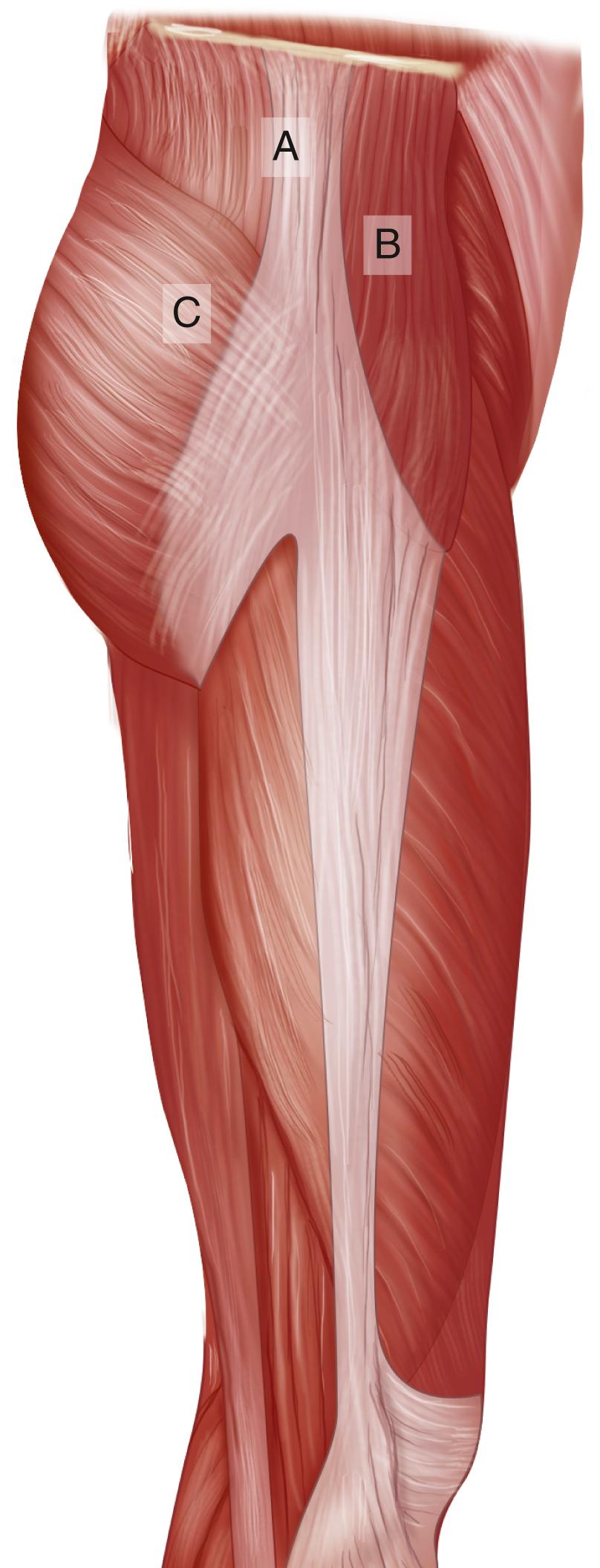 Fig. 33.3, The three-pronged attachment of the upper part of the iliotibial band to the iliac crest. There is a middle prong (A) through the aponeurosis over the gluteus medius, an anterior one (B) through the tensor fasciae latae, and a posterior one (C) through the gluteus maximus. Proximally, the location of the iliotibial tract is anterior and lateral to the axis of the hip, whereas inferiorly, in a normal knee, it inserts on the tibia well in front of the axis of the knee joint.