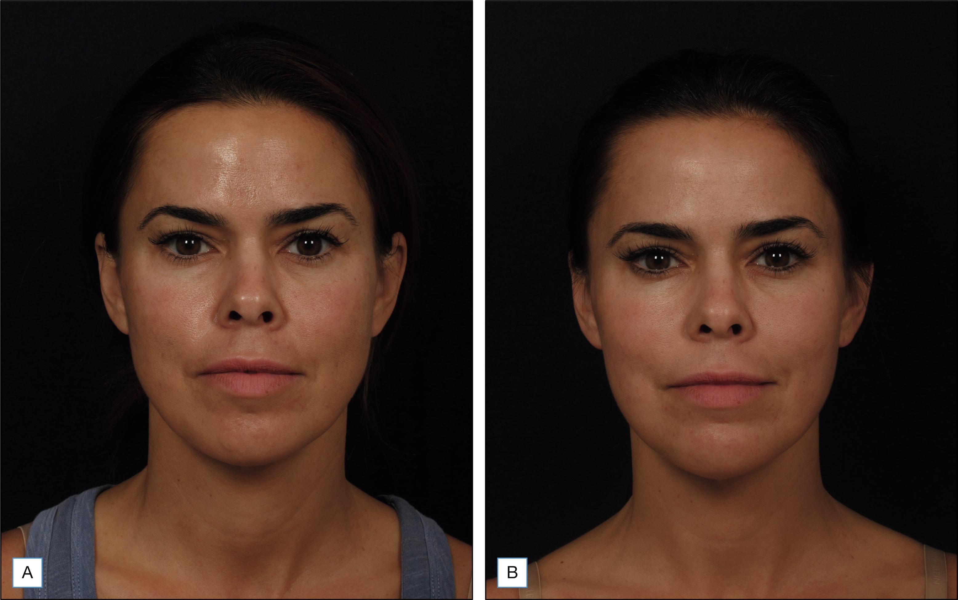 Fig. 10.1, A 41-year-old patient with aging changes superimposed on congenital skeletal hypoplasia before (A) and 4 weeks after (B) two vials of poly-L-lactic acid used panfacially as demonstrated with narration in the video provided for this chapter. Neuromodulater was used in the glabella. Note the increased brow projection, bizygomatic width, and improvement in perioral support giving an improved phi ratio to the lower third of the face. Note also the ovalization of the facial shape as well as improvement in skin quality. See the accompanying video for treatment of this patient.