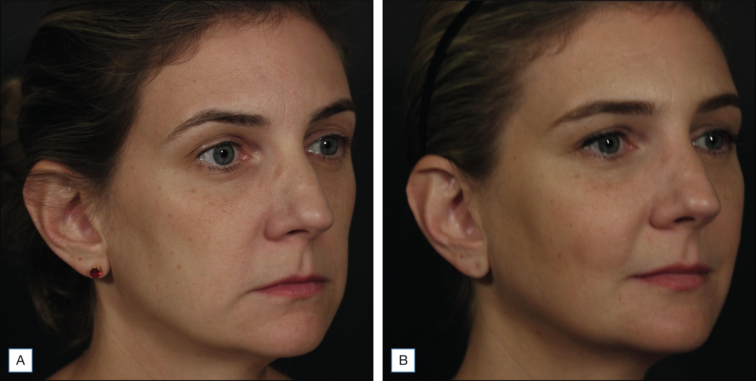 Fig. 10.3, A 38-year-old patient before (A) and 6 months after (B) poly-L-lactic acid two vials per session, three sessions spaced 1 month apart. Note the improvement in the anterior projection and convexity of the face as well as in skin quality. This athletic patient presented with significant loss of volume in her facial fat and therefore required more sessions than most patients her age.