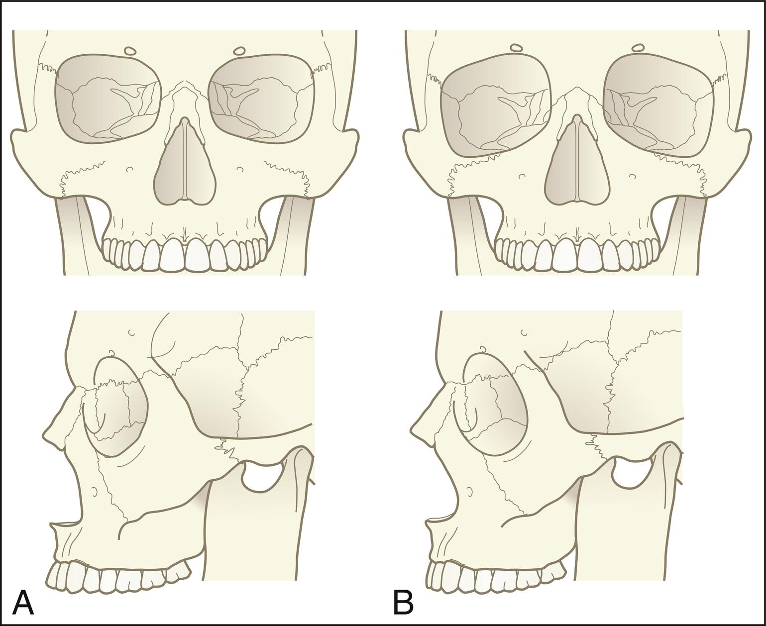 Fig. 10.5, A pictorial summary of age-related changes to the mid-face skeleton. (A) Features of a youthful skull include a malar eminence, infraorbital rim, and pyriform aperture that are positioned anterior and vertical in the sagittal plane. The orbital aperture is small with a horizontally positioned inferior orbital rim. (B) Older patients have a retroclined malar eminence, infraorbital rim, and pyriform aperture compared with that of young patients. The orbital aperture area is increased secondary to progressive curve distortion of the orbital rim superomedially and inferolaterally.