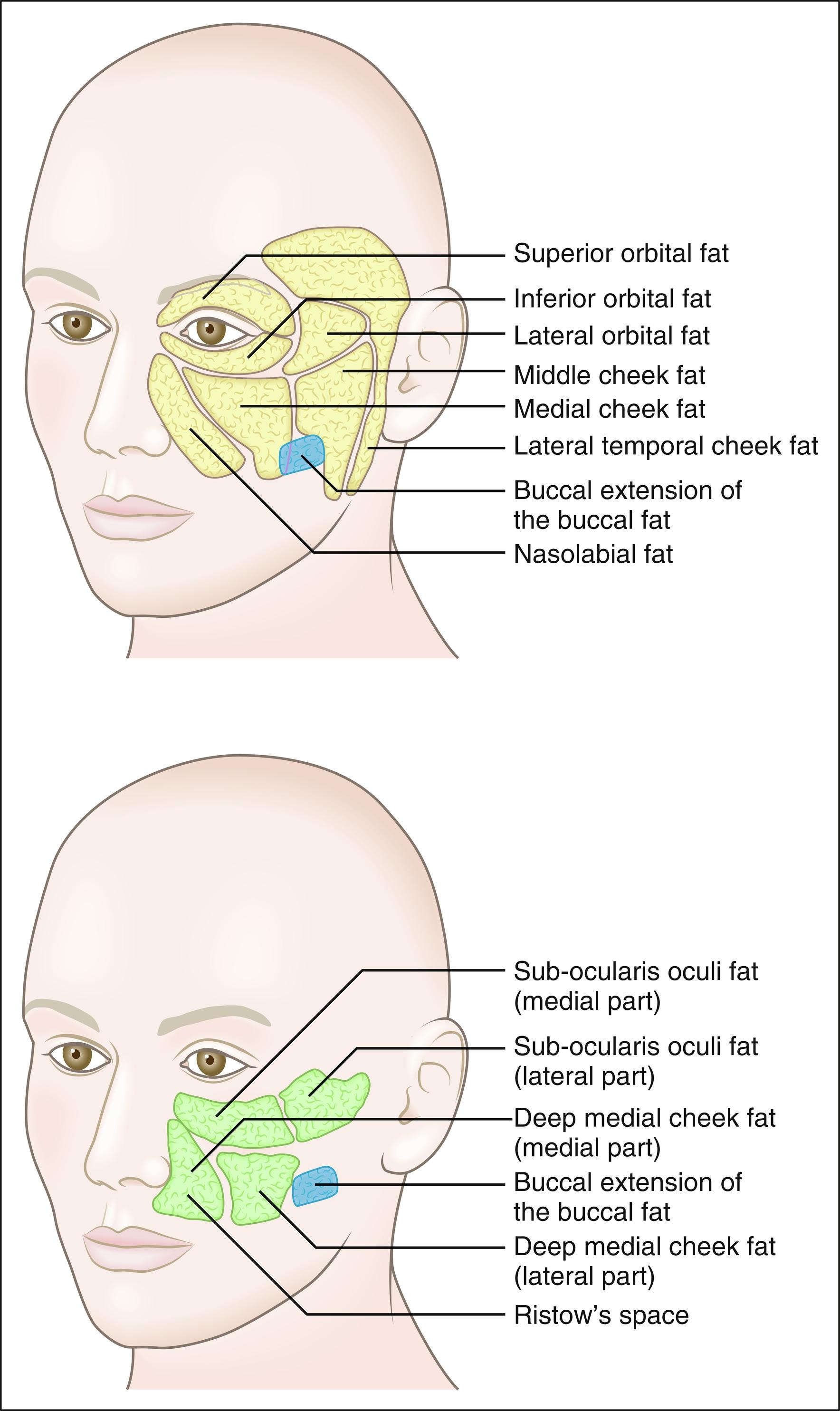 Fig. 10.6, Anatomical relationships of the superficial and deep facial fat compartments. The superficial layer (yellow) is composed of the nasolabial fat, the medial cheek fat, the middle cheek fat, the lateral temporal cheek compartment, and three orbital compartments. The deep midfacial fat compartments are composed of the sub-orbicularis oculi fat (medial and lateral parts) and the deep medial cheek fat (medial and lateral parts). Three layers of distinct fat compartments are found laterally to the pyriform aperture, where a deep compartment (blue) is located posterior to the medial part of the deep medial cheek fat. The buccal extension of the buccal fat pad extends from the paramaxillary space to the subcutaneous plane.