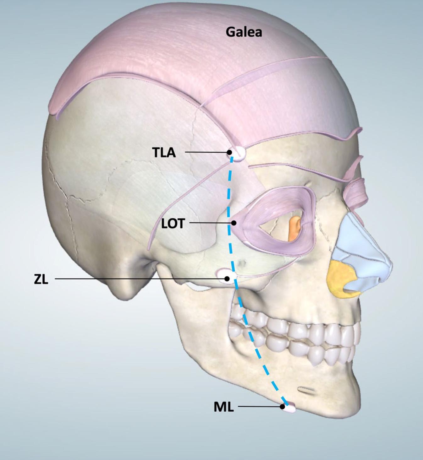 Fig. 10.7, Model of the face showing the major facial ligaments. Note how the ligaments can be aligned into one line located immediately lateral to the lateral orbital rim extending from the temporal crest to the mandible, creating the line of ligaments (indicated in blue ). LOT , Lateral orbital thickening; ML , mandibular ligament; TLA , temporal ligamentous adhesion; ZL , zygomatic ligament.