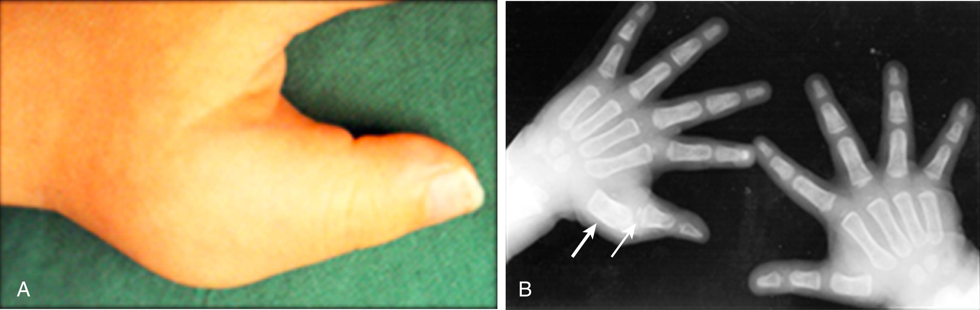 Fig. 18.1, Images of an 18-month-old boy presenting with seronegative polyarticular juvenile idiopathic arthritis (JIA). Swelling of the right thumb was associated with clinical signs of intraarticular fluid and synovial hypertrophy ( A ) and radiographic evidence ( B ) of soft tissue swelling, bony overgrowth of the first metacarpal ( thick arrow ) and premature ossification of the proximal phalange growth center ( thin arrow ).