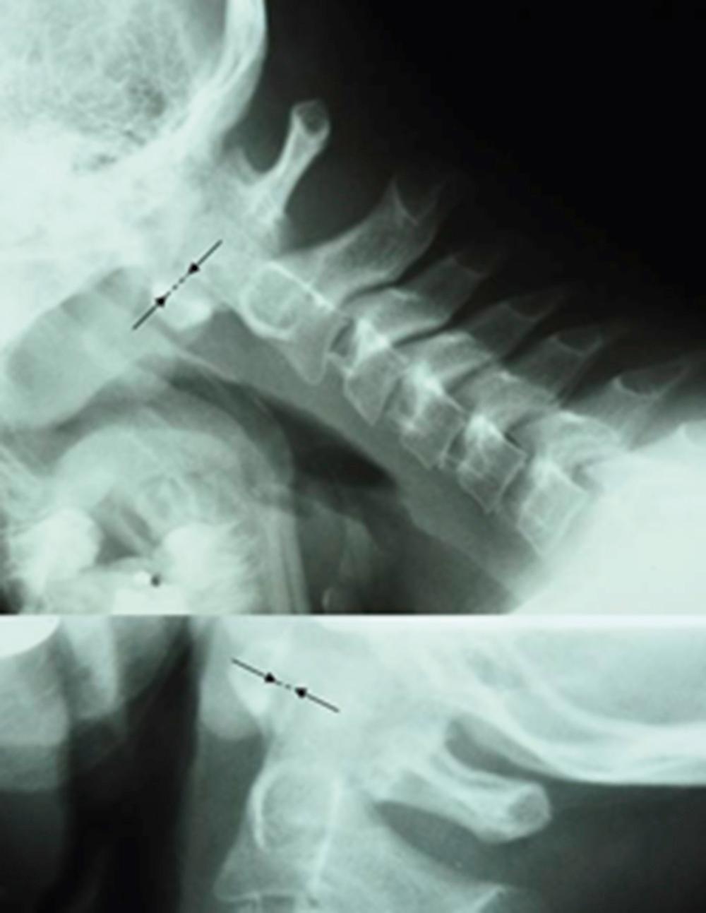 Fig. 18.3, Flexion ( top ) and extension ( bottom ) radiographs of the cervical spine of a child with rheumatoid factor (RF)-negative polyarthritis. The increased distance between the posterior surface of the anterior arch of the first cervical vertebra and the anterior margin of the odontoid ( arrows ) in flexion suggests mild atlantoaxial subluxation in this patient.