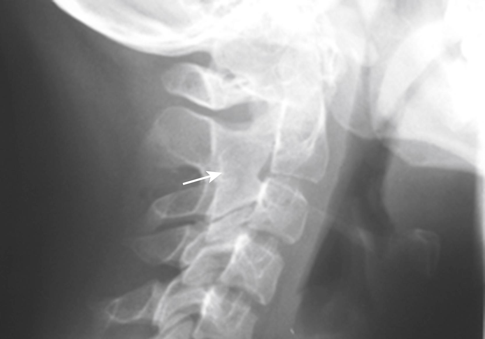 Fig. 18.4, Lateral radiograph of the cervical spine of a child with rheumatoid factor (RF)-negative polyarthritis showing bony ankylosis of the second and third cervical vertebra.