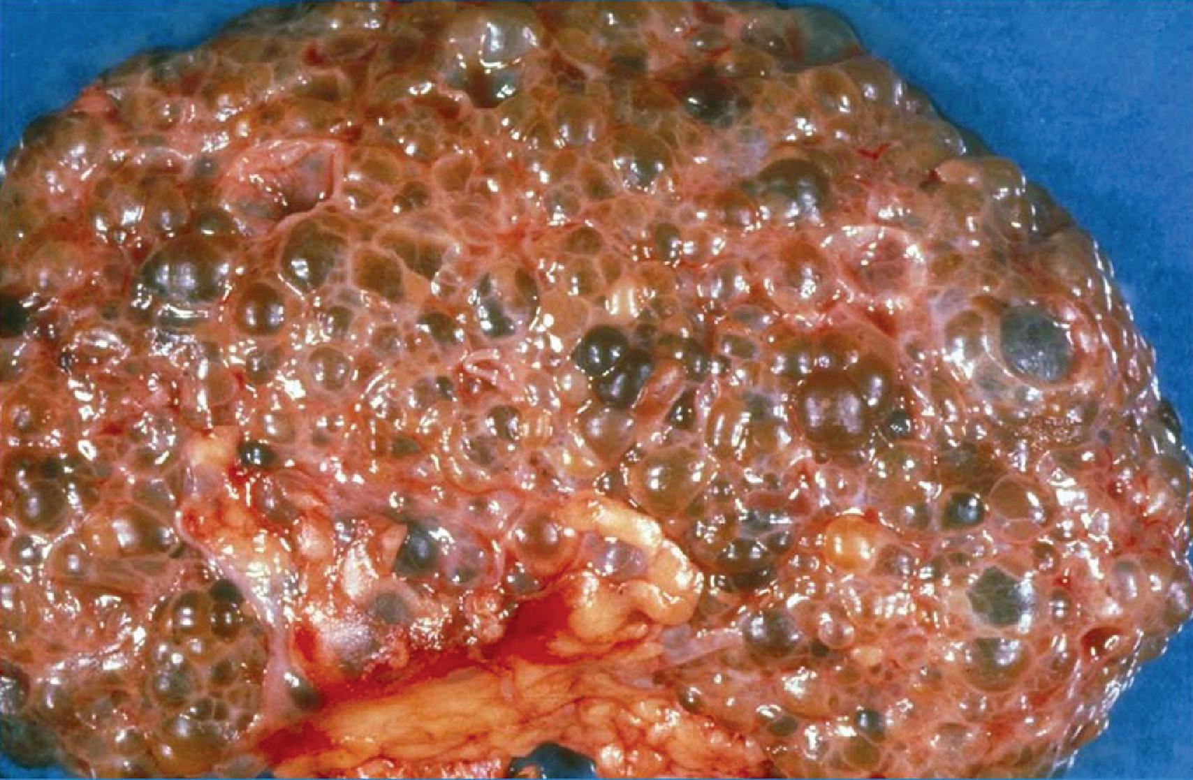 Fig. 39.2, Gross pathology of autosomal dominant polycystic kidney disease.