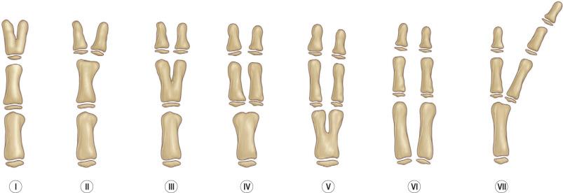 FIG. 5.2.1, Wassel classification of radial polydactyly.