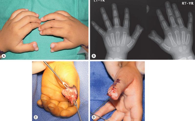 FIG. 5.2.2, Bilateral Wassel type II thumb duplication. (A) Clinical presentation. (B) Radiographic examination. (C) Surgical reconstruction of left Wassel type II thumb duplication. Ligamentoperiosteal elevated distally from the radial thumb is seen with suture material at its distal end. (D) A neurovascular pedicle flap from the radial thumb was used to reconstruct the eponychial fold of the retained thumb.