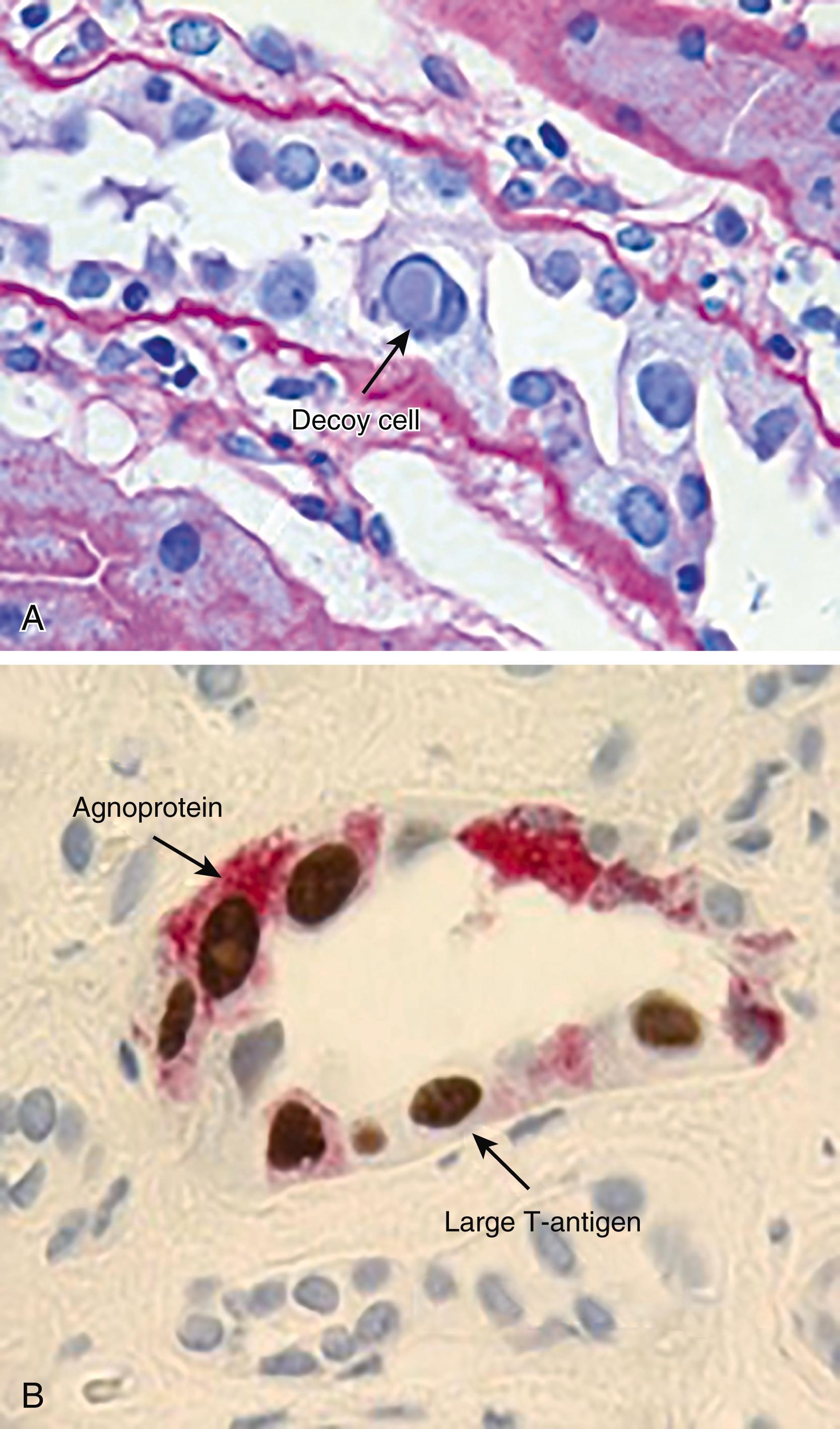 E-FIGURE 341-1, BK Polyomavirus nephropathy in a kidney allograft biopsy. A, Renal tubule in tangential cut showing rounded enlarged tubular cells with prominent nucleus and intranuclear ground-glass inclusions. Inflammatory infiltrates are seen in the interstitium and in the epithelial tubular lining with mononuclear cells and granulocytes. (Hematoxylin and eosin stain, magnification 1000×) B, Renal tubule in cross-sectional cut showing BK polyomavirus replication side-by-side in early and late phase by immunohistochemistry for the cytoplasmic agnoprotein (red) and the nuclear large tumor antigen (brown), partly displaced by intranuclear inclusions (light brown) (magnification 1000×).