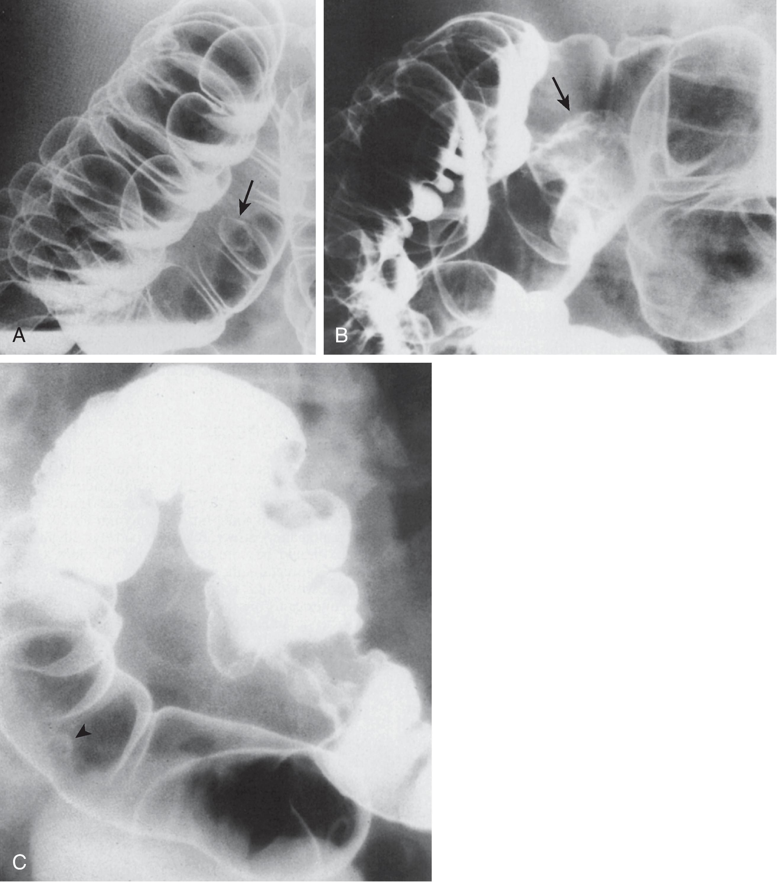 Fig. 43.1, Double-contrast barium enema: evaluation of colon cancer.