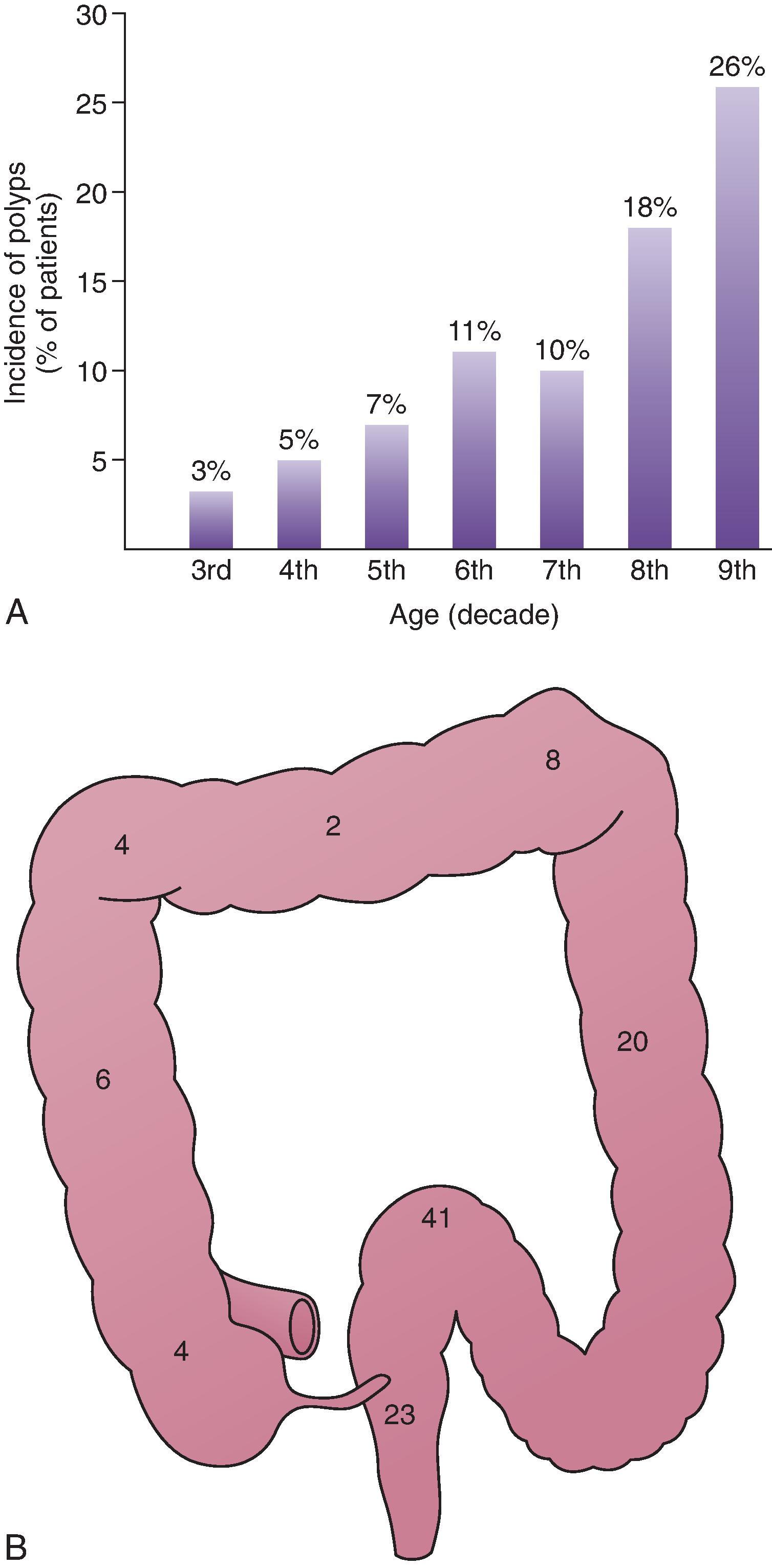 Fig. 43.2, Incidence and distribution of colorectal polyps.