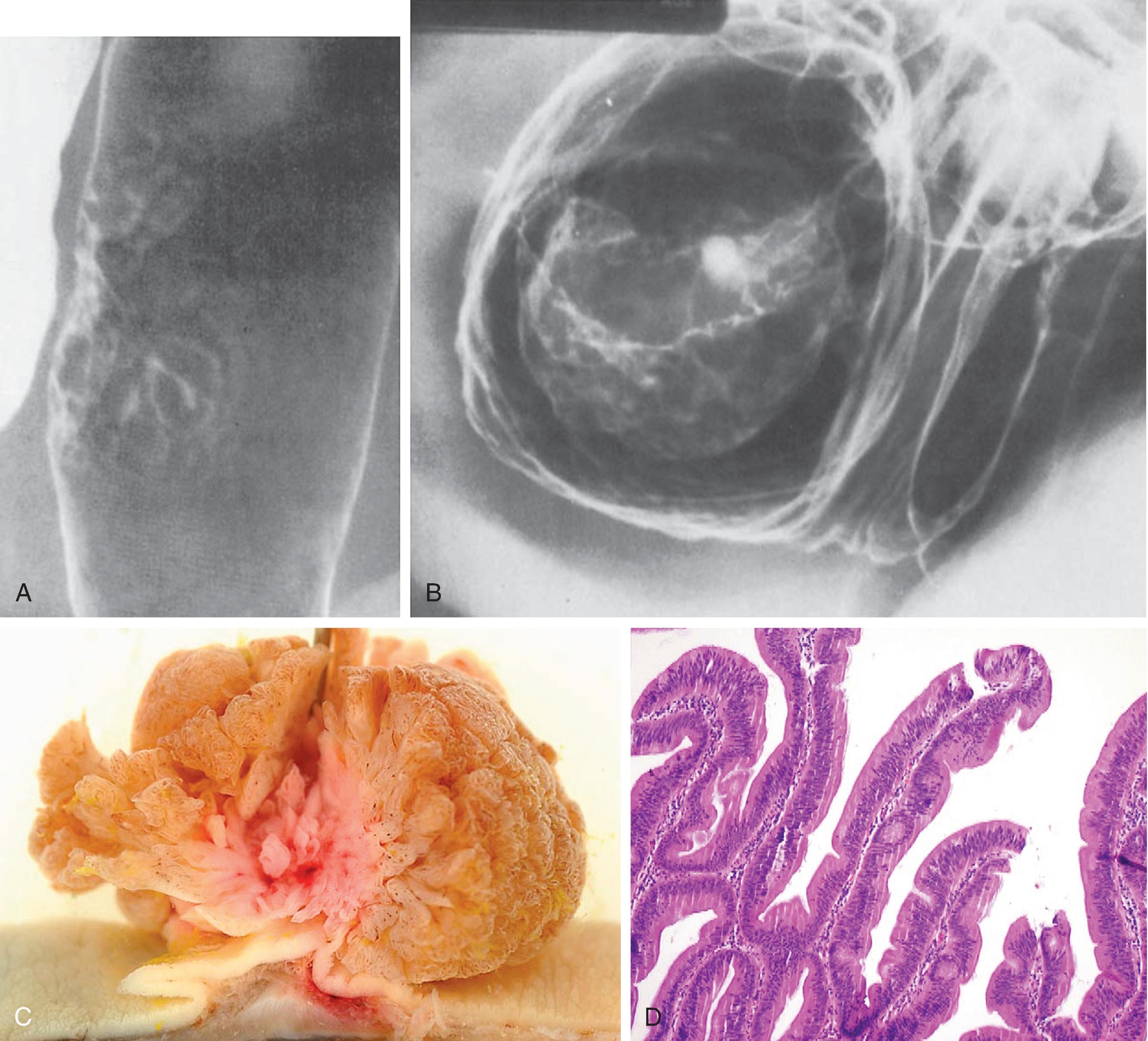 Fig. 43.4, Villous adenomas.