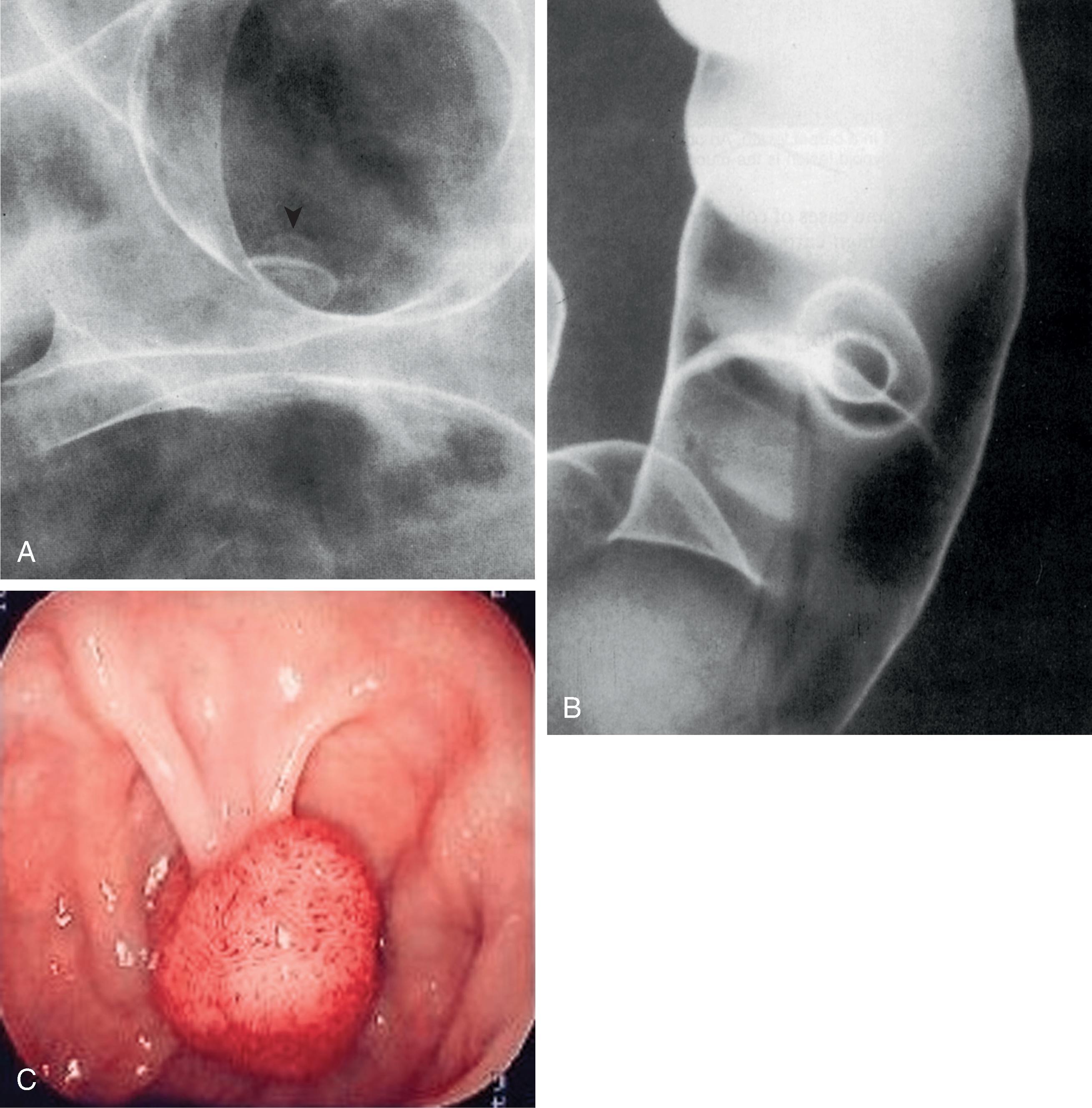Fig. 43.5, Double-contrast barium enema and colonoscopic features of polyps.