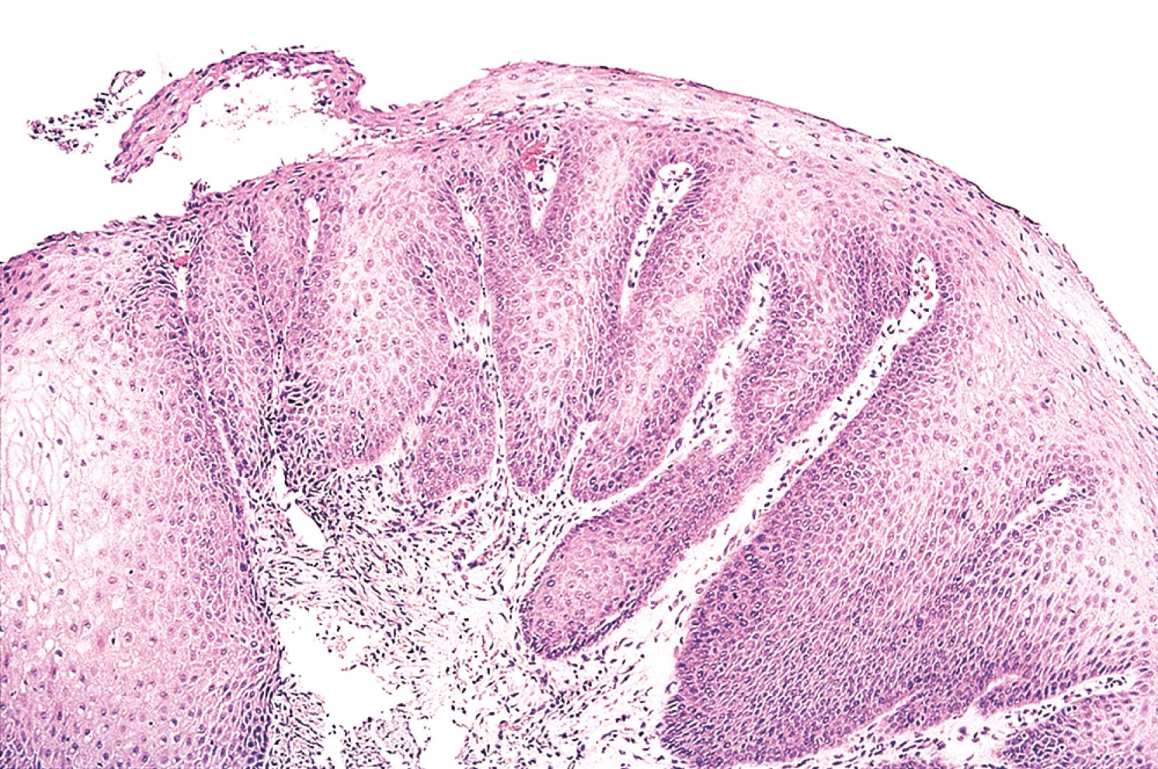 FIGURE 19.1, Squamous-lined inflammatory polyps have an endophytic growth pattern characterized by elongated tongues of benign squamous epithelium extending into the underlying lamina propria. These lesions may represent a subtype of squamous papilloma.